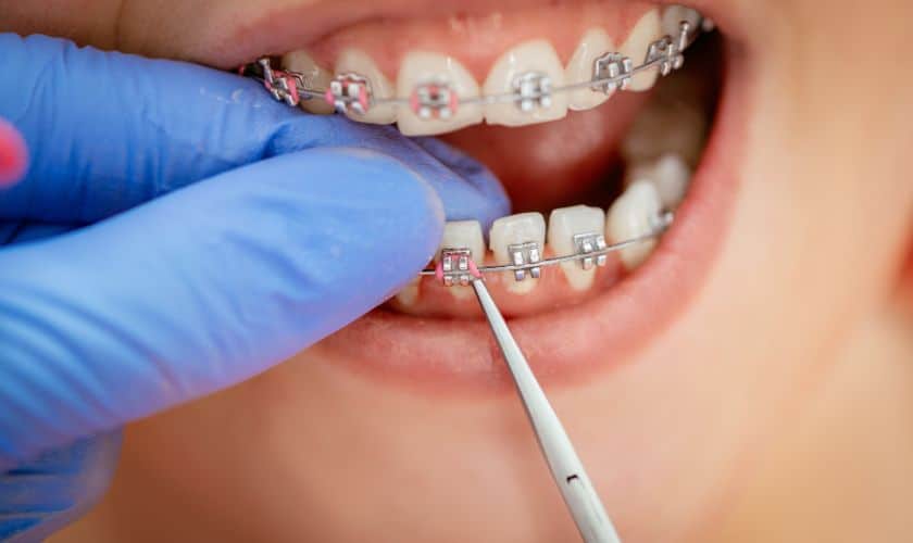Braces Cost​
